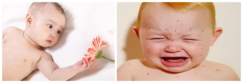 兒童濕疹反反復(fù)復(fù),您有在家安裝家用除濕產(chǎn)品嗎?_重復(fù)